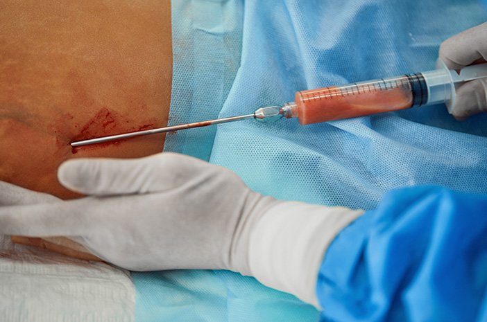 Usai Sedot Lemak di Klinik Kecantikan, Perempuan Ini Meninggal Dunia